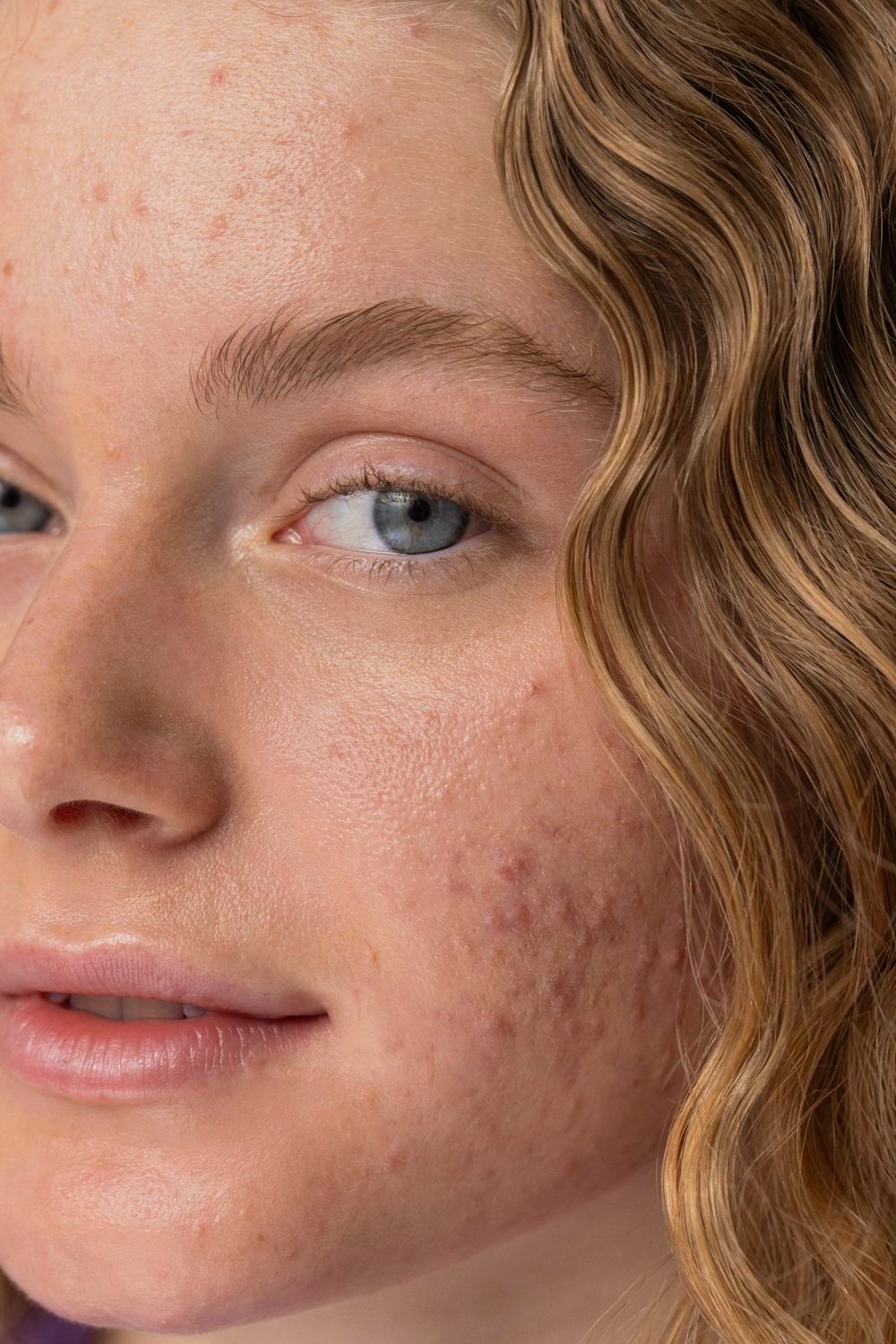 Acne & Breakouts