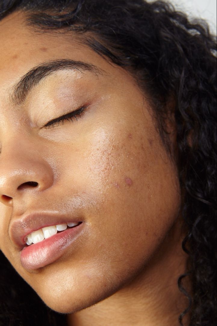 Hyperpigmentation